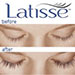 Latisse Latisse