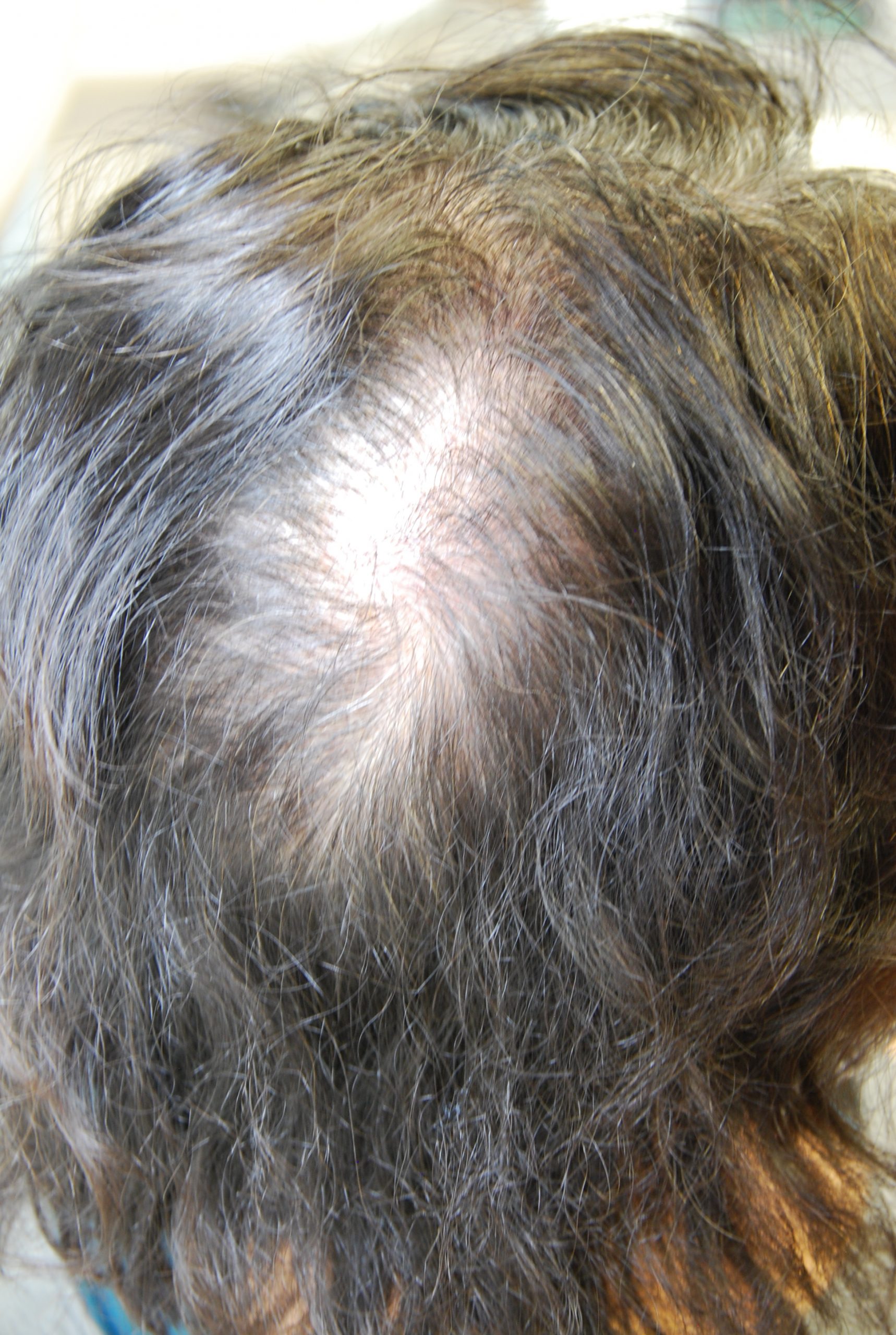 PRP for hair loss and regrowth; before